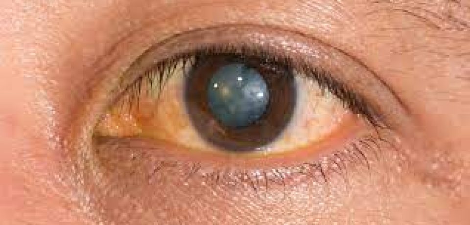 Cataract Symptoms-How To Diagnose Them?